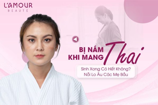 Bị Nám Khi Mang Thai, Sinh Xong Có Hết Không? 