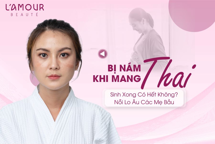 Bị Nám Khi Mang Thai, Sinh Xong Có Hết Không?