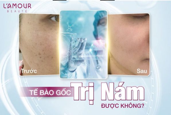 Tế Bào Gốc Trị Nám Được Không?