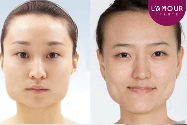 Hiểu về tiêm Botox mặt lệch  